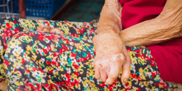 SPDM apoia lançamento do Apelo Global pelo Fim do Estigma e da Discriminação contra as Pessoas Atingidas pela Hanseníase e suas Famílias