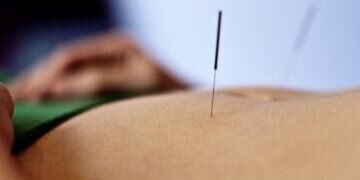 acupuncture