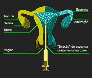 inseminacao uterina1
