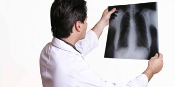 SUS começa a oferecer teste rápido para tuberculose