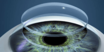 Transplante-de-cornea