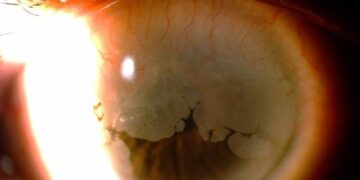 HPV que provoca câncer de colo de útero também causa tumor no olho