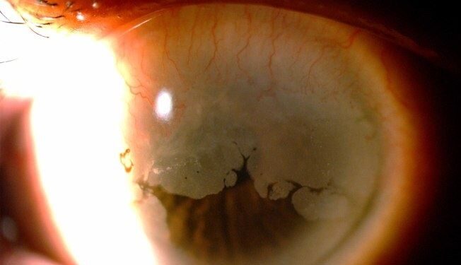 Exemplo de lesão cancerígena no olho causada pelo HPV