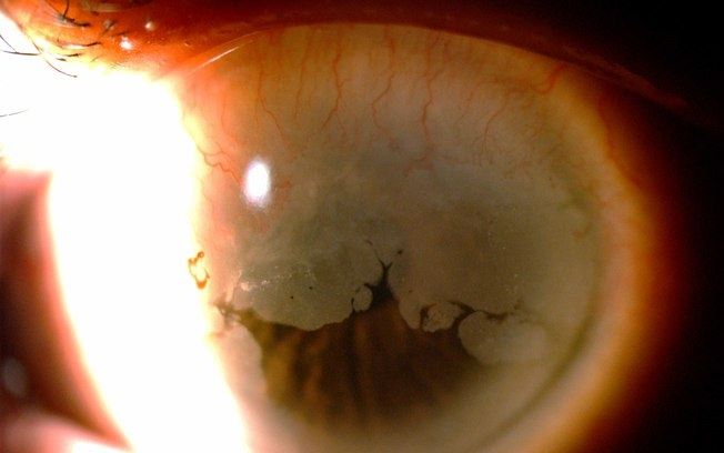 Exemplo de lesão cancerígena no olho causada pelo HPV