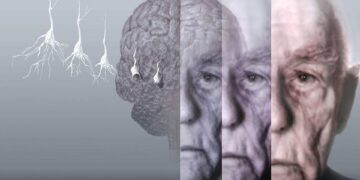 Quando o esquecimento começa a afetar o dia a dia, procure um médico. Pode ser Alzheimer!