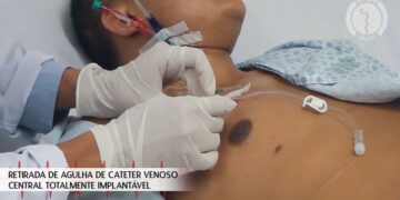Retirada de Agulha de Cateter Venoso Central Totalmente Implantável