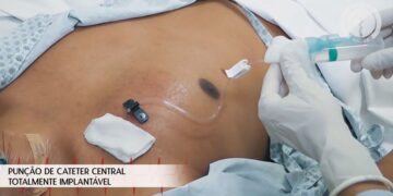 Punção de Cateter Venoso Central Totalmente Implantável