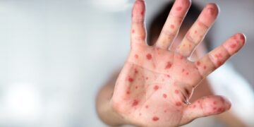 Sarampo – Saiba por que é importante prevenir