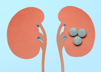 Cálculo renal – causas, sintomas e tratamento