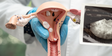 Síndrome do Ovário Policístico