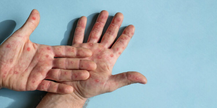 MPOX no Brasil