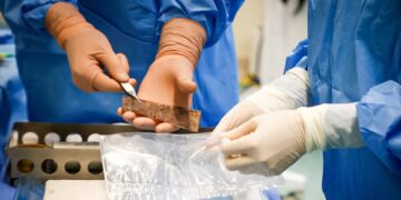 Hospital Pedro II realiza primeiro transplante de pele post mortem