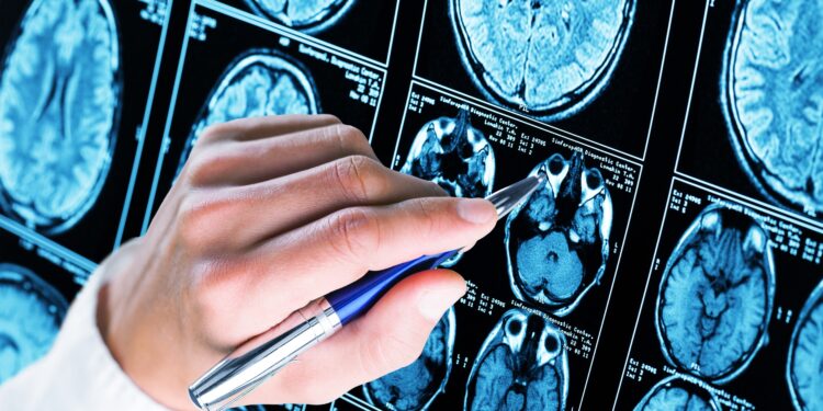 Diagnóstico de Alzheimer e Fevereiro Roxo