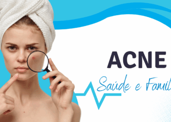 ACNE: Sintomas, Causas e Cuidados