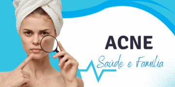 ACNE: Sintomas, Causas e Cuidados