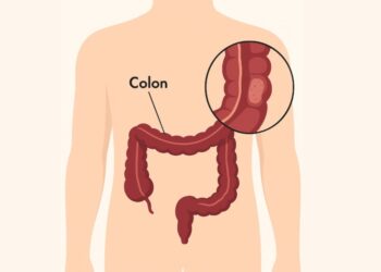 O que é retocolite ulcerativa?