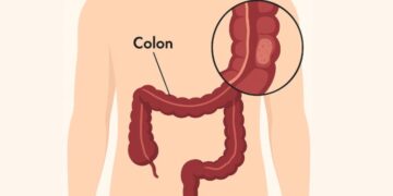 O que é retocolite ulcerativa?