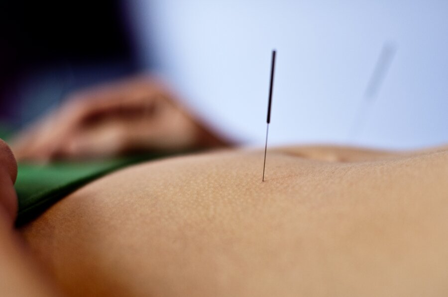 acupuncture
