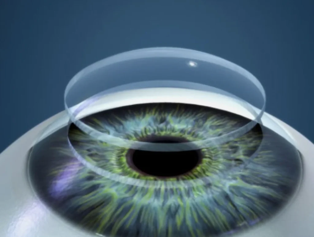 Transplante-de-cornea