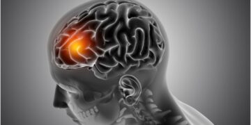 Ilustração médica em 3D de cérebro humano com destaque em área iluminada indicando lesão ou atividade anormal