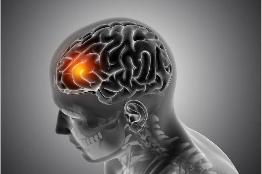 Ilustração médica em 3D de cérebro humano com destaque em área iluminada indicando lesão ou atividade anormal