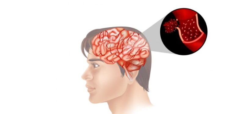 avc hemorragico