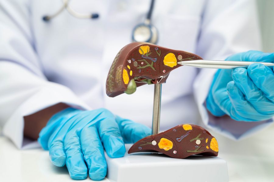 Modelo anatômico do fígado com alterações ilustradas.